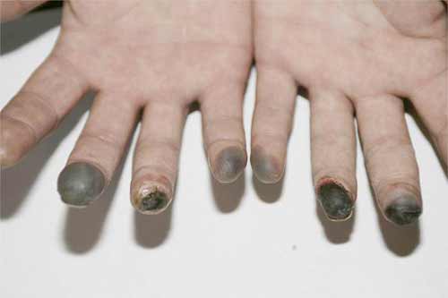 На Полтавщині госпіталізували 57-річного чоловіка з обмороженням пальців обох рук