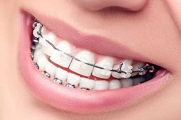 Выравнивание зубов с помощью брекет-системы