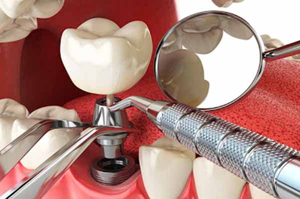 Что такое зубные импланты