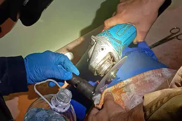 рятувальники вивільнили палець підлітка з металевого предмета