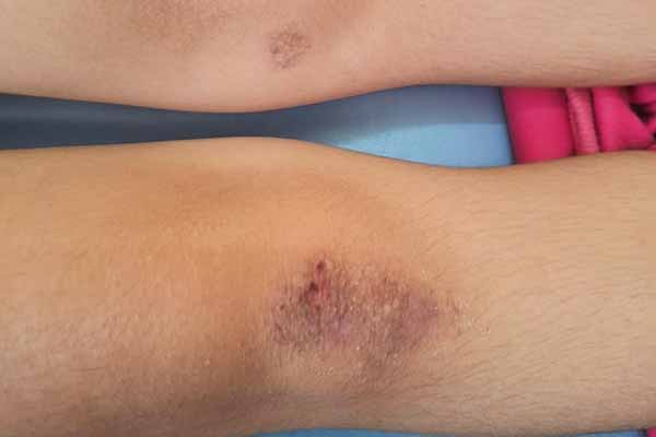 На Полтавщині опікунку підозрюють у катуванні молодших сестер