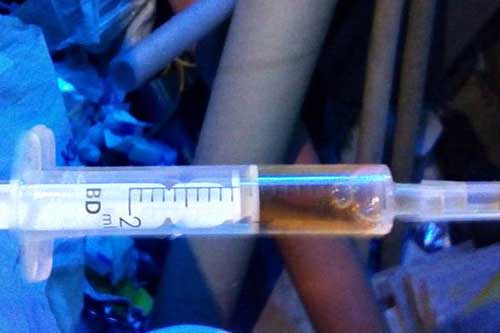 Поліцейські Лубенщини вилучили у місцевого жителя наркотичний засіб опій ацетильований