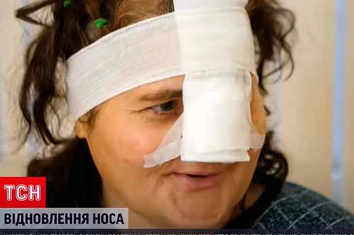 На Полтавщині собака відкусила ніс жінці-листоноші