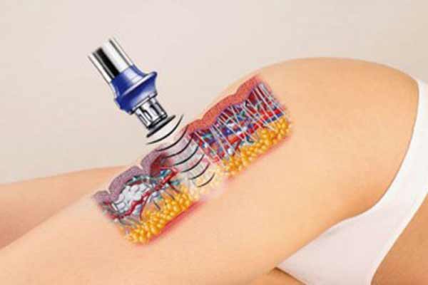 Лечения целлюлита методом ударно-волновой терапии