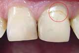 Почему чернеет зуб под пломбой и может ли полеченный зуб разрушаться?