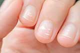 На які небезпечні порушення можуть вказувати білі смужки на нігтях?