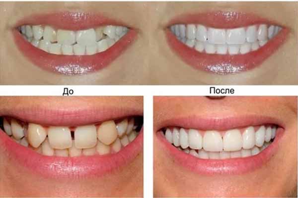  Художественная реставрация зубов 