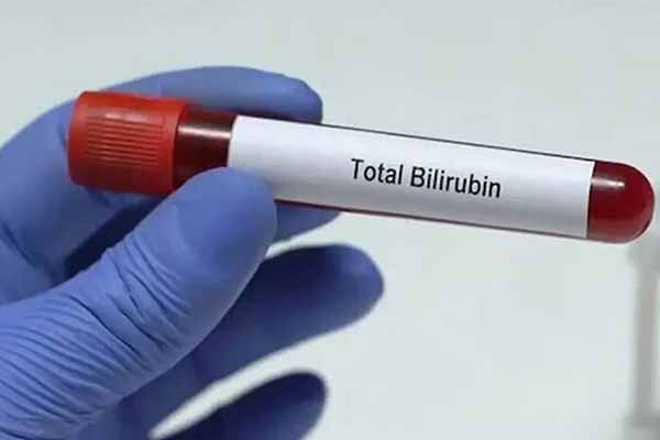 Як визначити рівень білірубіну? Як визначити рівень білірубіну?