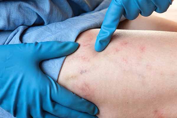 Тромбэктомия из артерий нижних конечностей: показа...