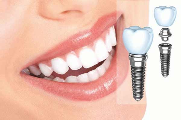 Двухэтапная имплантация зубов