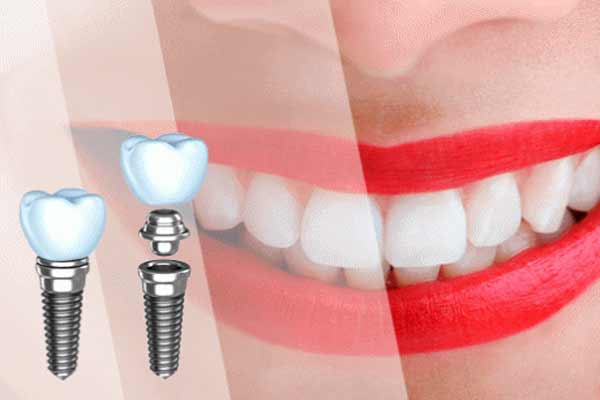 Как происходит установка имплантатов