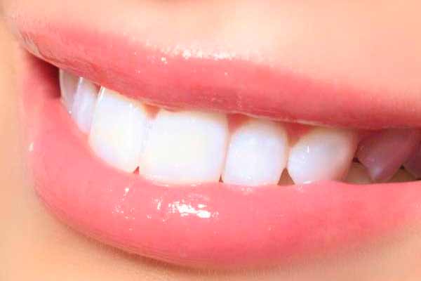  Відбілювання зубів без шкоди 