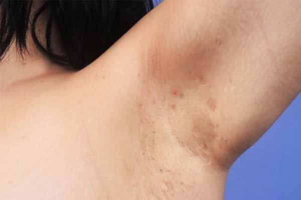 Всесвітній день боротьби з хворобою Вернейля