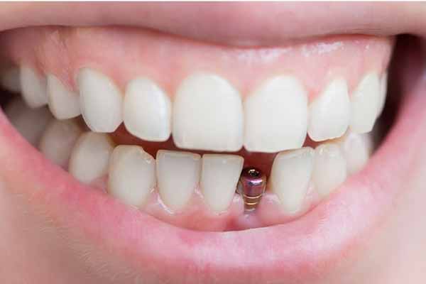  Имплантация <b>зубов</b>, как эффективный метод восстановления 