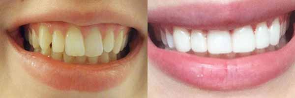 Як встановити прямі вініри недорого і за один візит до стоматолога