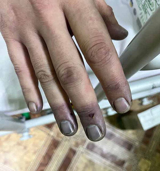 Житель Полтавщини отримав обмороження