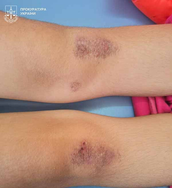 На Полтавщині опікунку підозрюють у катуванні молодших сестер