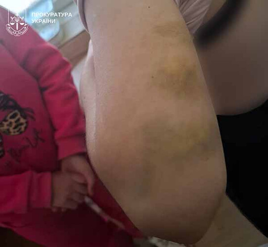 На Полтавщині опікунку підозрюють у катуванні молодших сестер