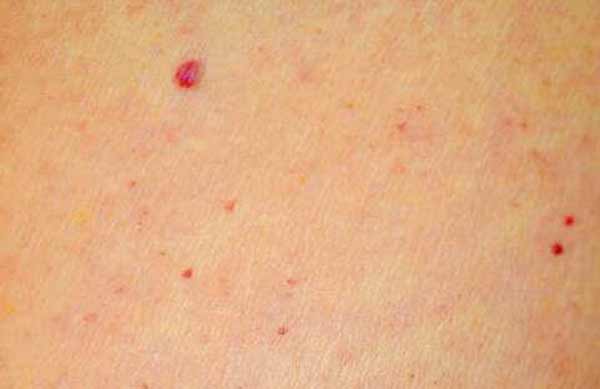 Чи варто хвилюватись через червоні цятки на шкірі? Чи варто хвилюватись через червоні цятки на шкірі?