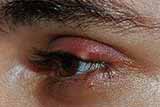 Ячмень (заболевание глаз) - симптомы и осложнения заболевания, лечение ячменя