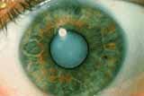  Катаракта (<b>болезнь</b> глаза) - стадии, виды, лечение катаракты 