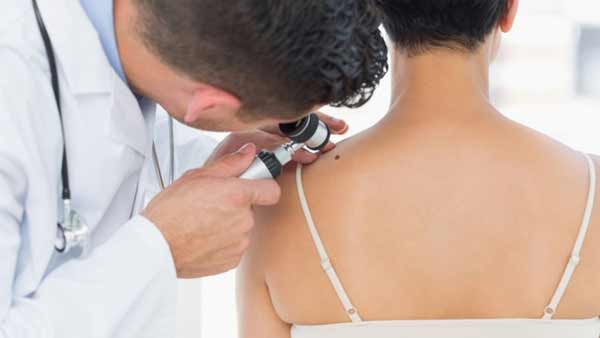 Как избавиться от папиллом?