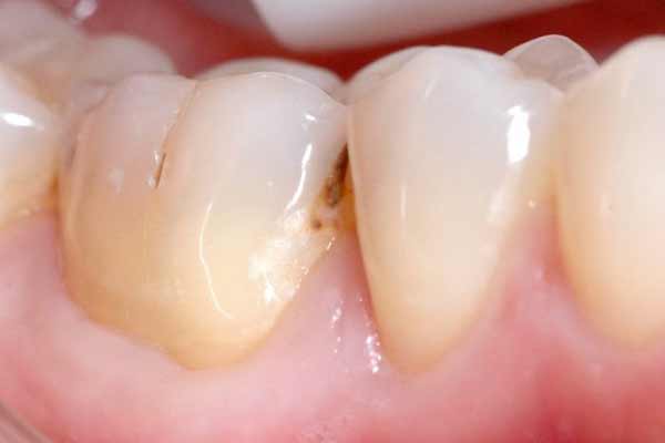 разрушение зуба вокруг пломбы