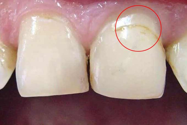  Почему чернеет <b>зуб</b> под пломбой и может ли полеченный <b>зуб</b> разрушаться? 