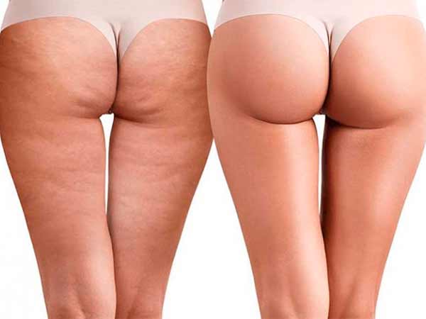 Міф 3: Целюліт з'являється тільки у повних жінок